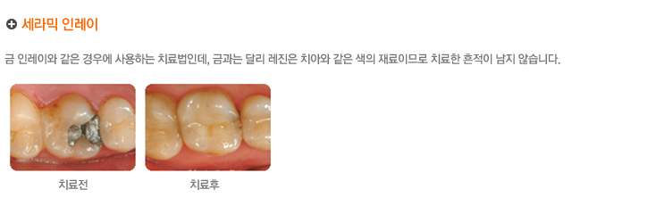 세라믹 인레이
금 인레이와 같은 경우에 사용하는 치료법인데, 금과는 달리 레진은 치아와 같은 색의 재료이므로 치료한 흔적이 남지 않습니다.